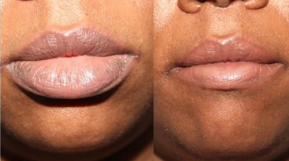 Lip Reduction