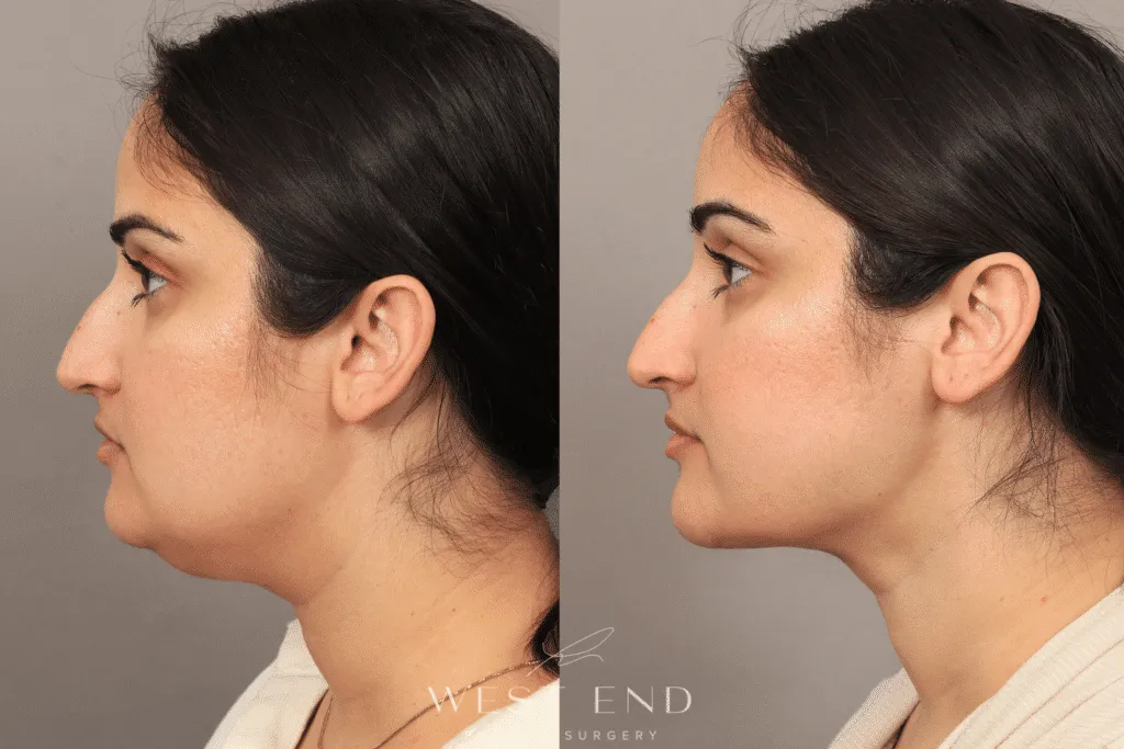 Neck Liposuction