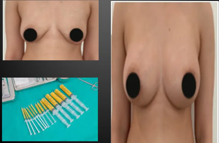 Breast Fat Grafting