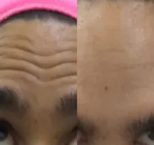 Forehead Wrinkles (Botox)