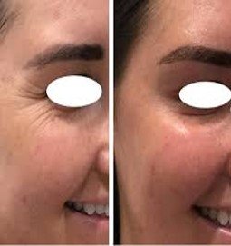 Crow’s Feet (Botox)