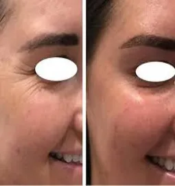 Crow’s Feet (Botox)