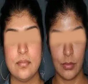 Masseter Botox