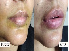 Lip Fillers