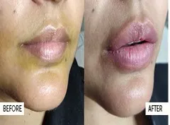 Lip Fillers