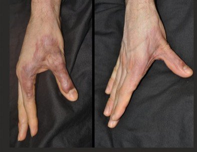 Post Burn Scar Hypertrophy (CO2 Laser)