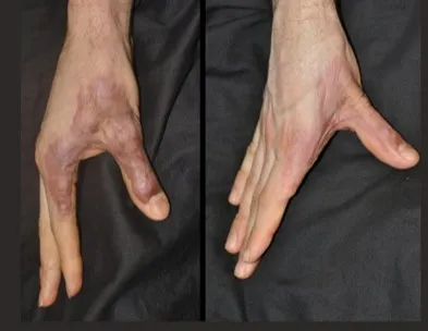 Post Burn Scar Hypertrophy (CO2 Laser)