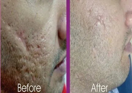 Post Acne Scars (CO2 Laser)