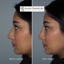 Nose Fillers