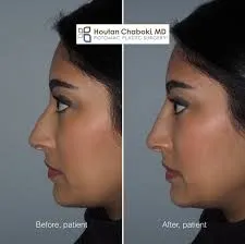 Nose Fillers