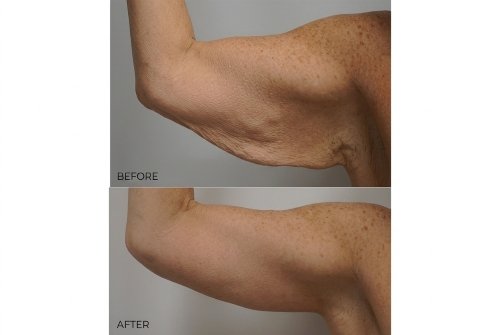 Arm lift/ brachioplasty