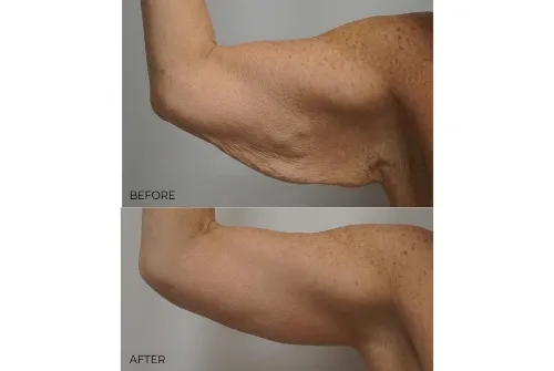 Arm lift/ brachioplasty