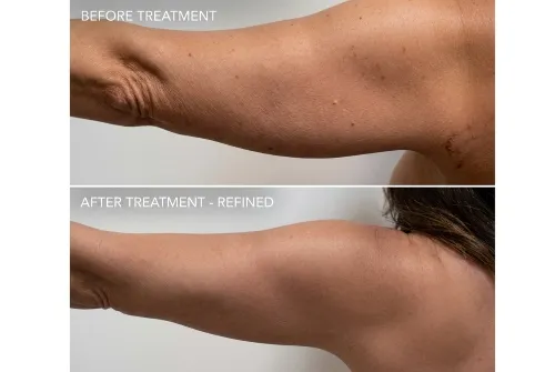 Arm liposuction
