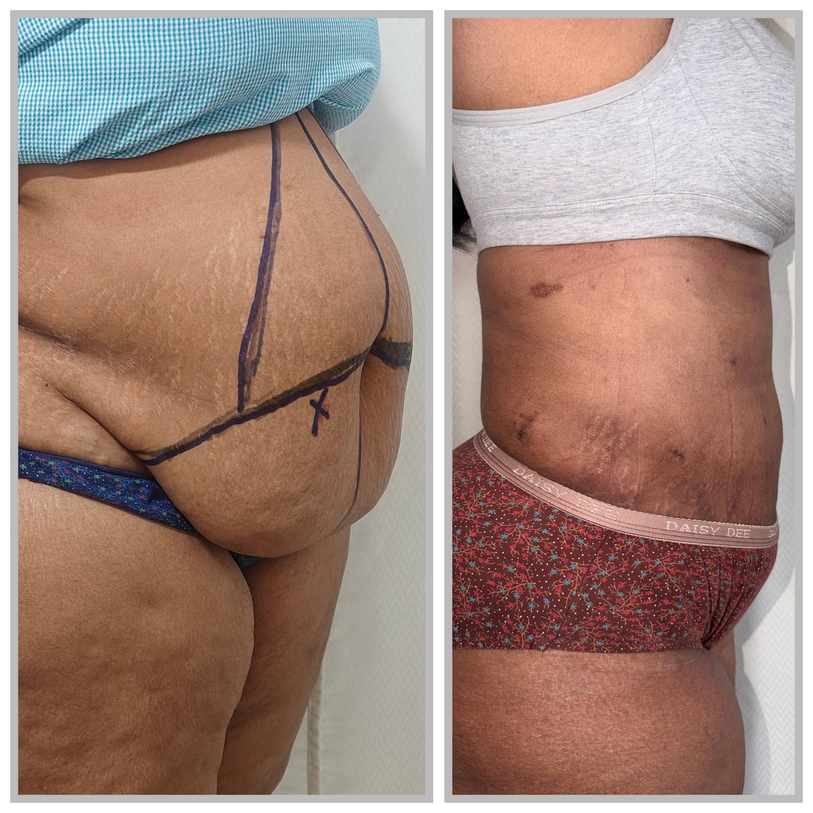 Abdominoplasty