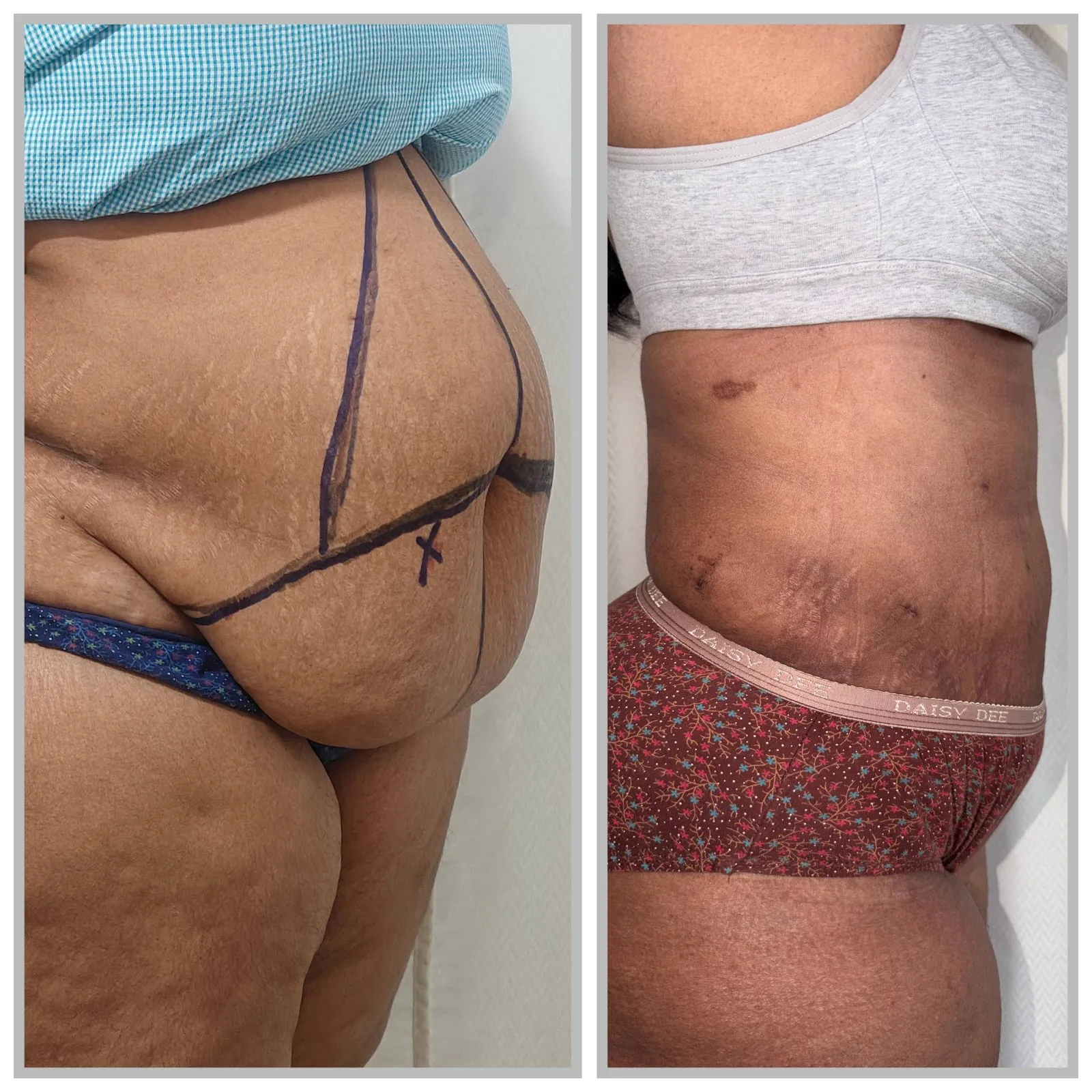 Abdominoplasty