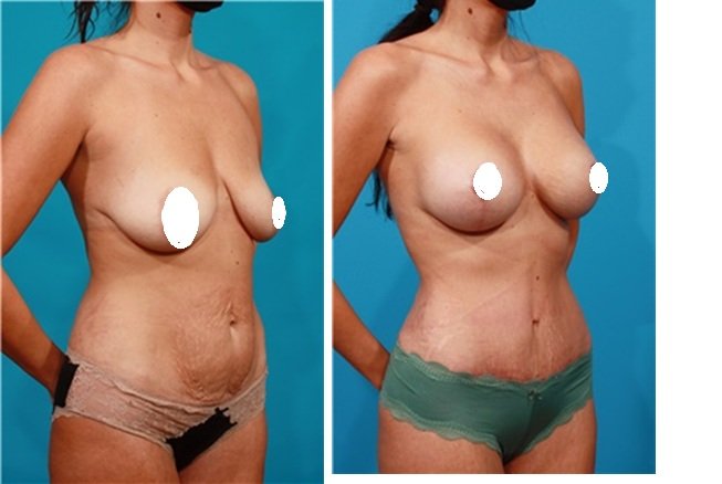 Breast Lift