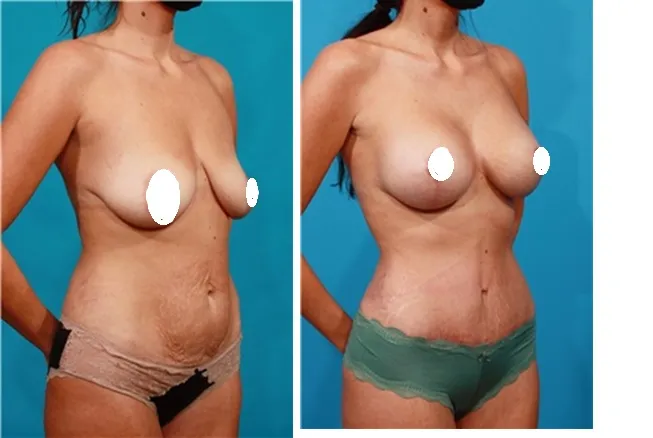 Breast Lift