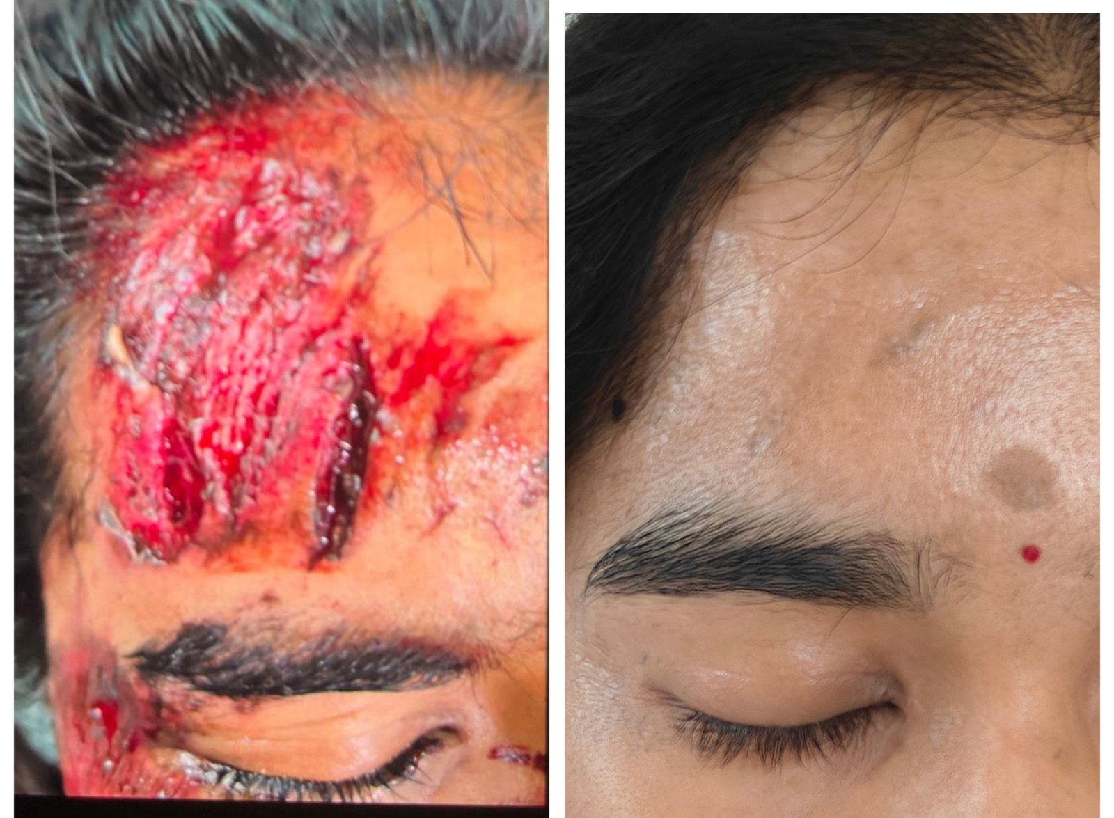 Scar Revision