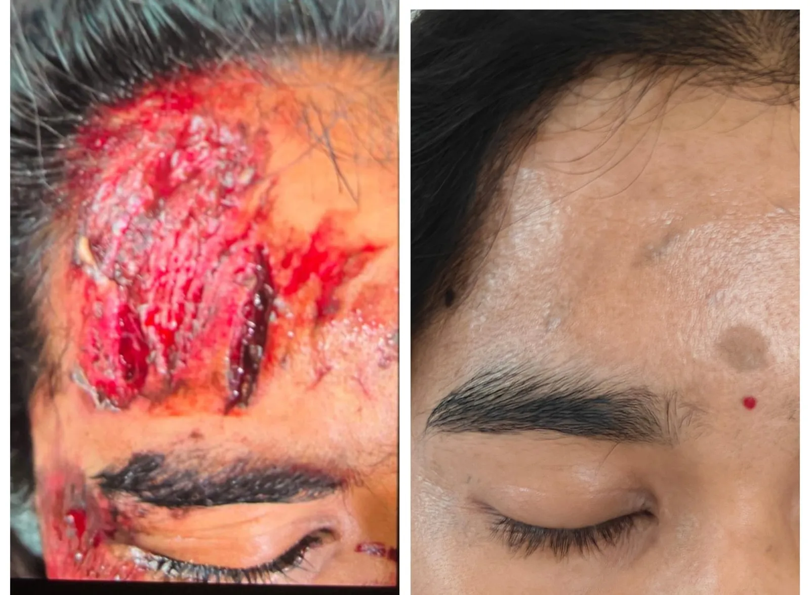 Scar Revision