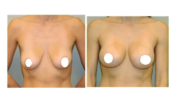 Breast Augmentation