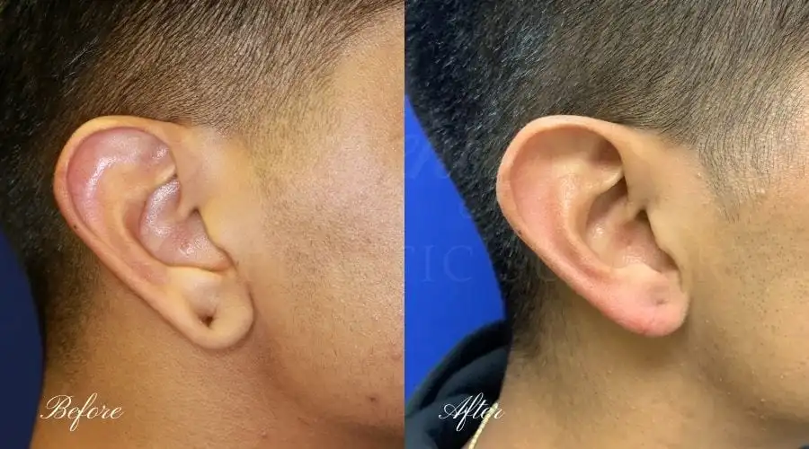 Ear Lobe Necrosis Treatment in Vizag