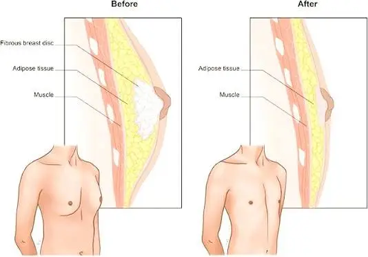 Gynecomastia Surgery in Vizag