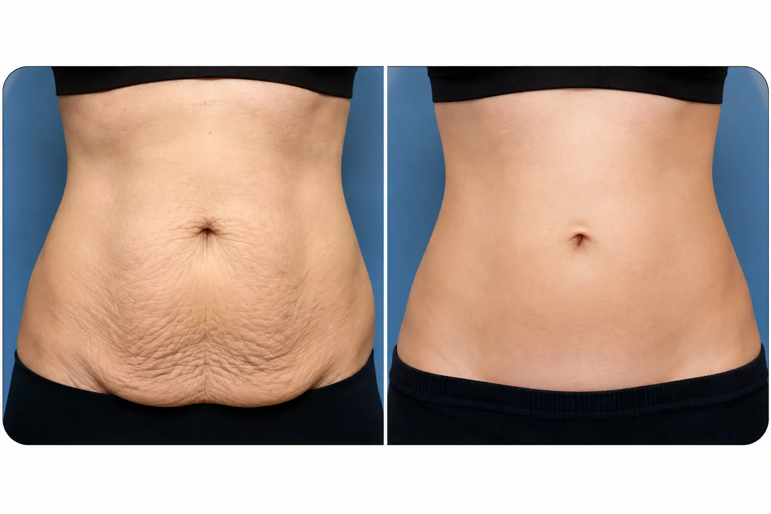 Tummy Tuck Surgery in Visakhapatnam: What Patients Should Know Before Booking