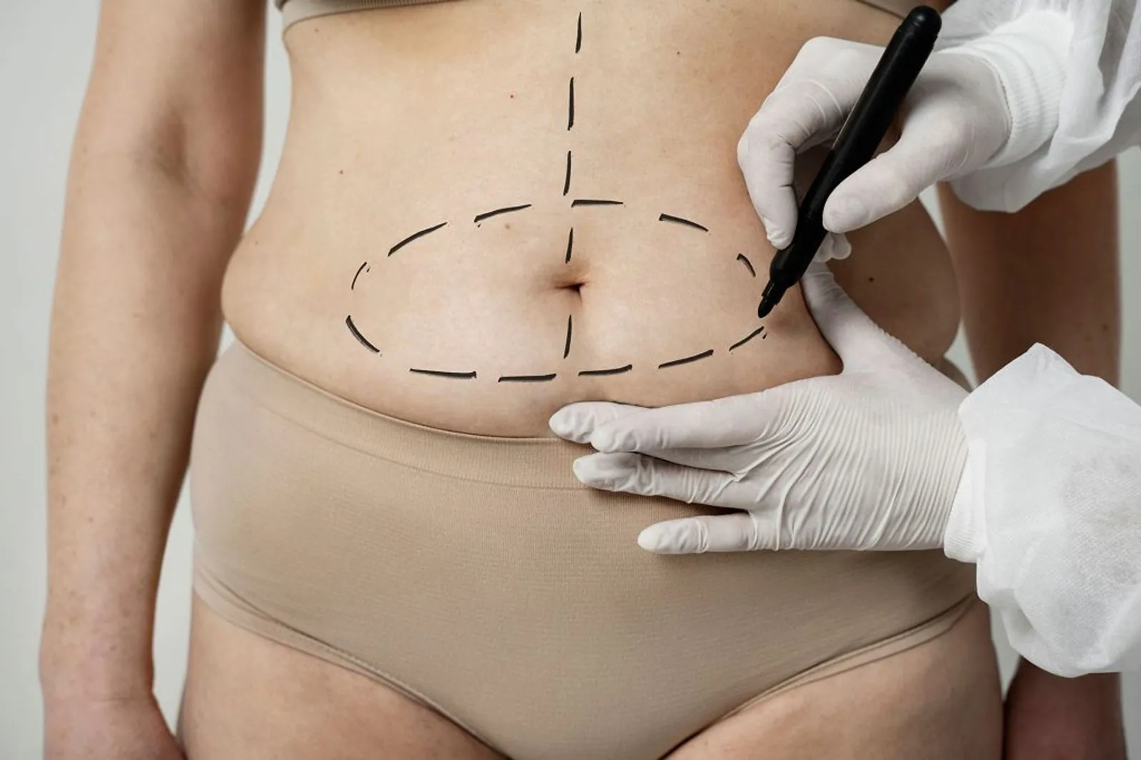 Body contouring — liposuction, tummy tuck and body lift