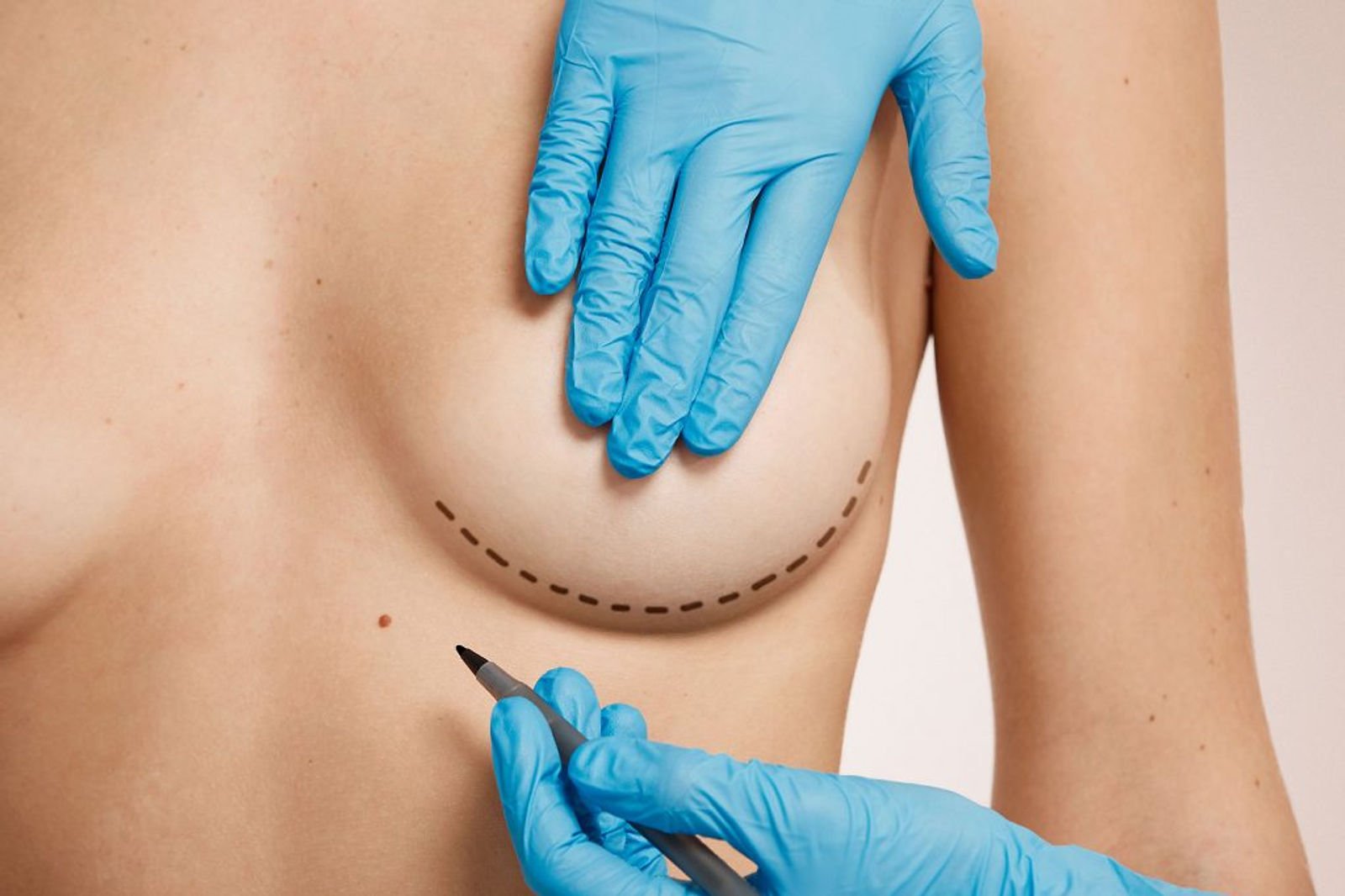 Breast Surgery