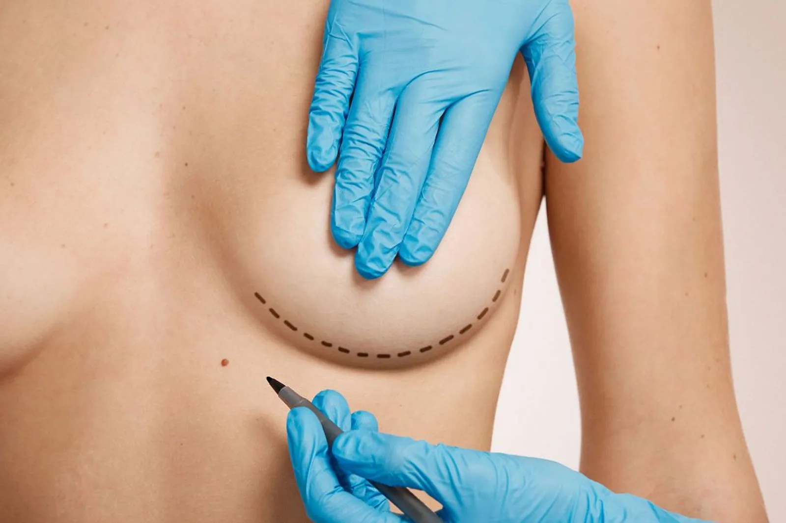 Breast surgery — augmentation, reduction and lift