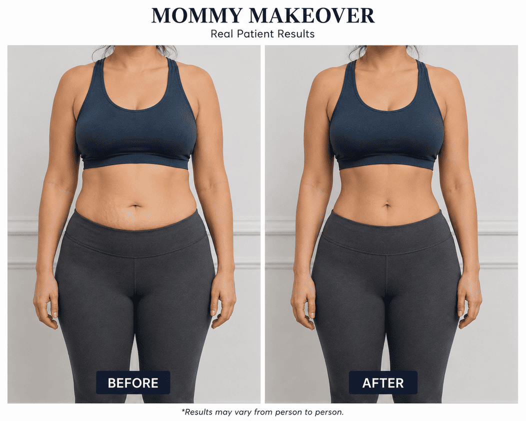 Mommy Makeover