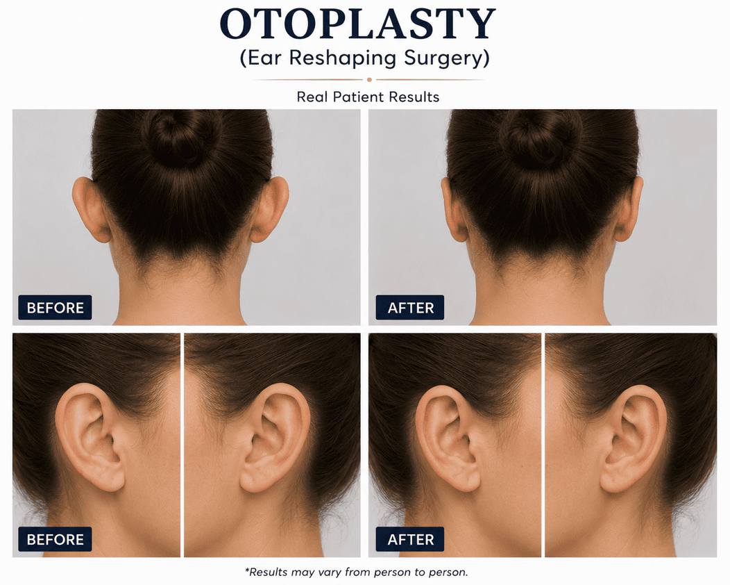 Otoplasty (Ear Reshaping Surgery)