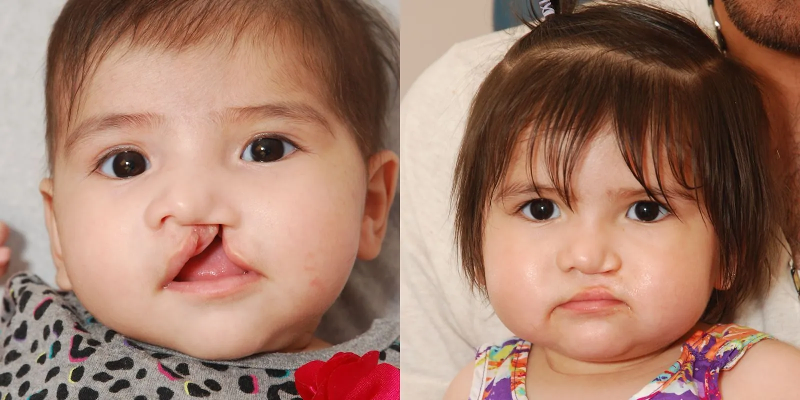 Cleft Lip & Palate Repair