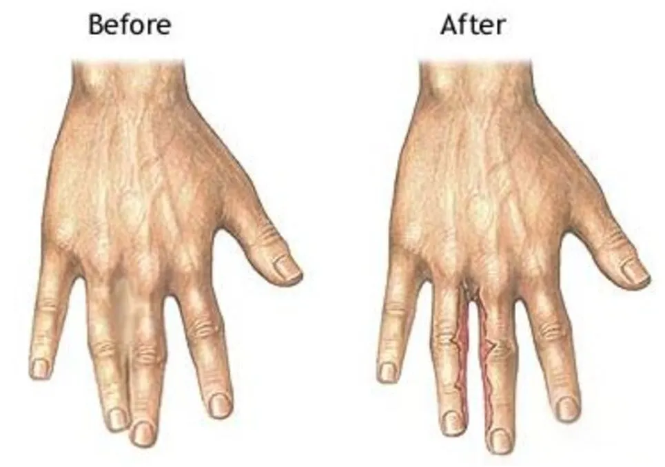 Hand Surgery & Syndactyly Correction