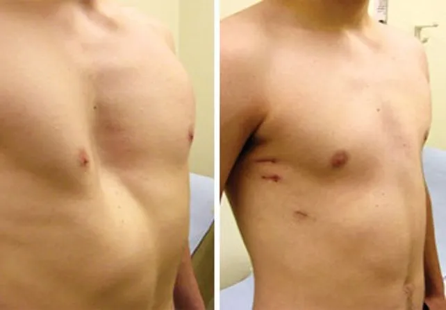 Flap Surgery & Microsurgery
