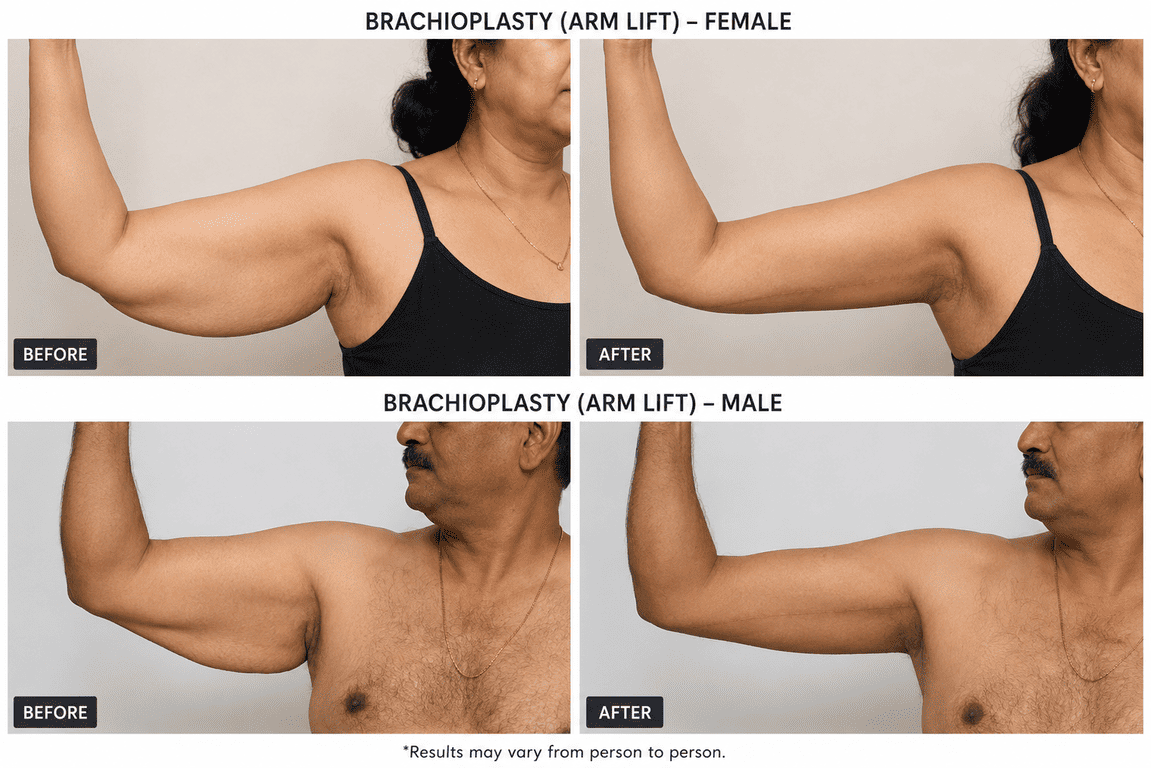 Brachioplasty