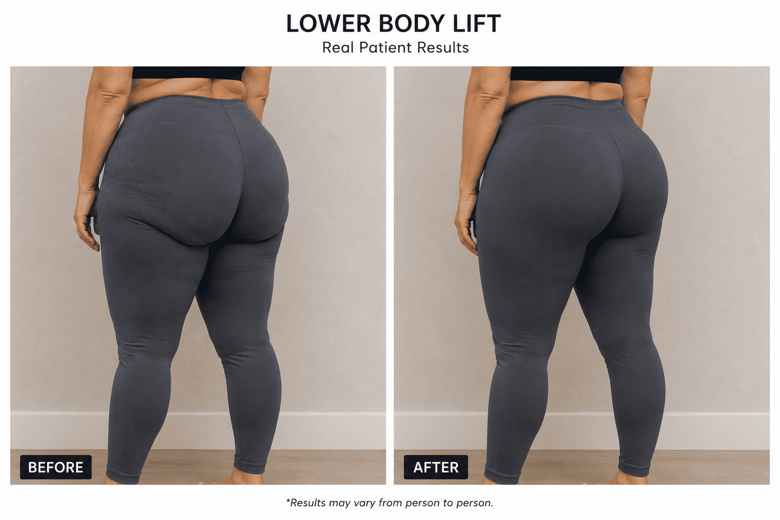 Lower Body Lift