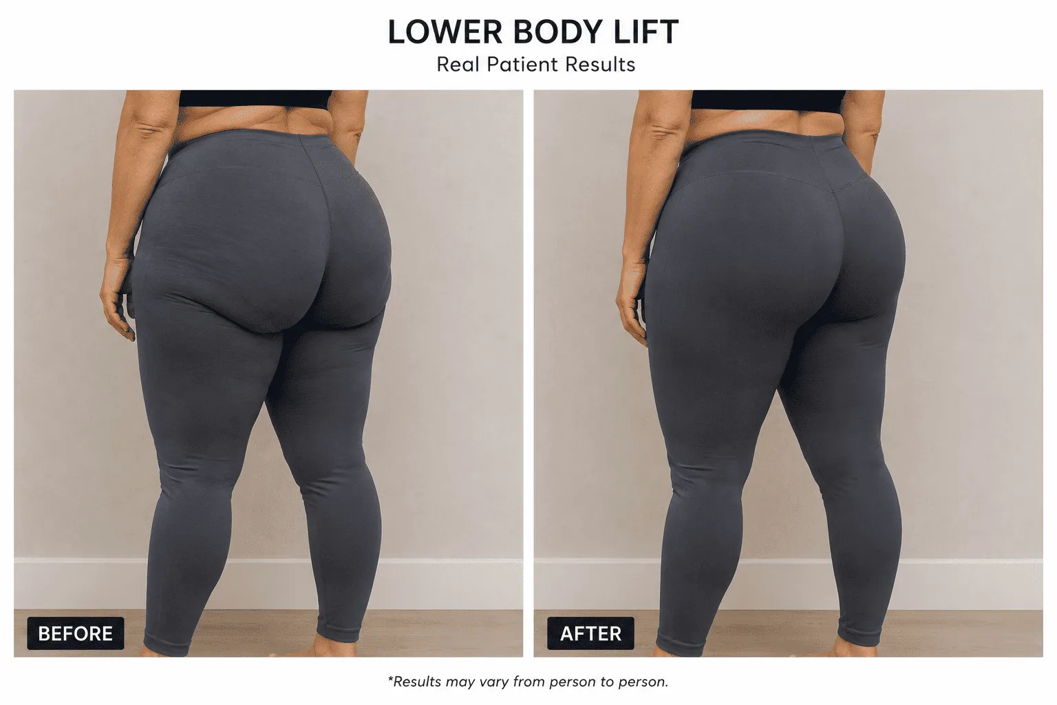 Lower Body Lift
